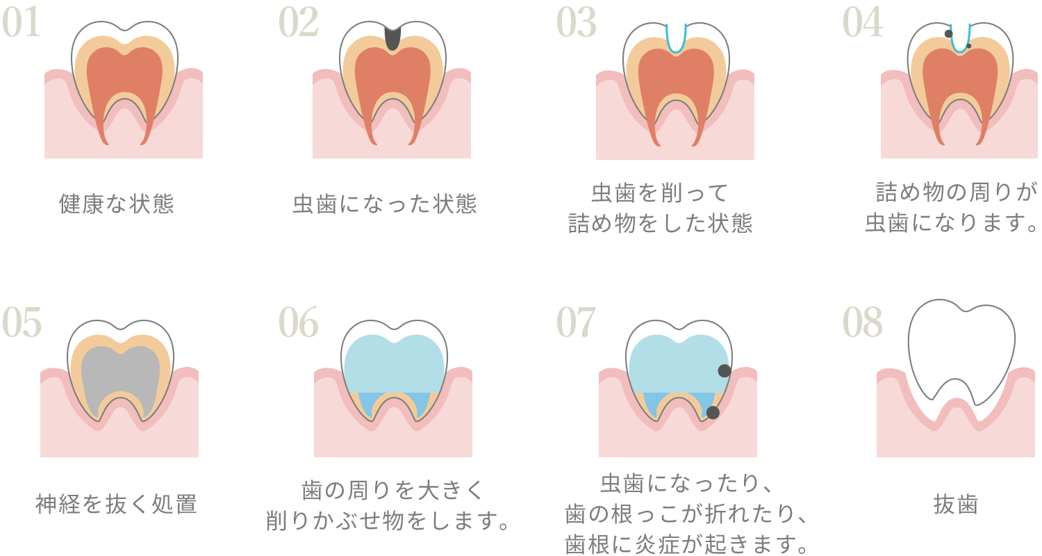 虫歯の流れのイラスト